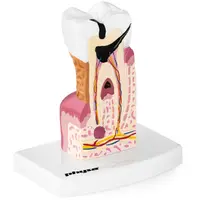 Modello anatomico dente - molare malato