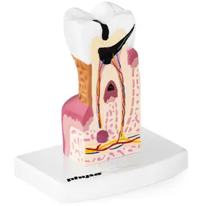 Maquette anatomique de la dentition humaine - Molaire malade