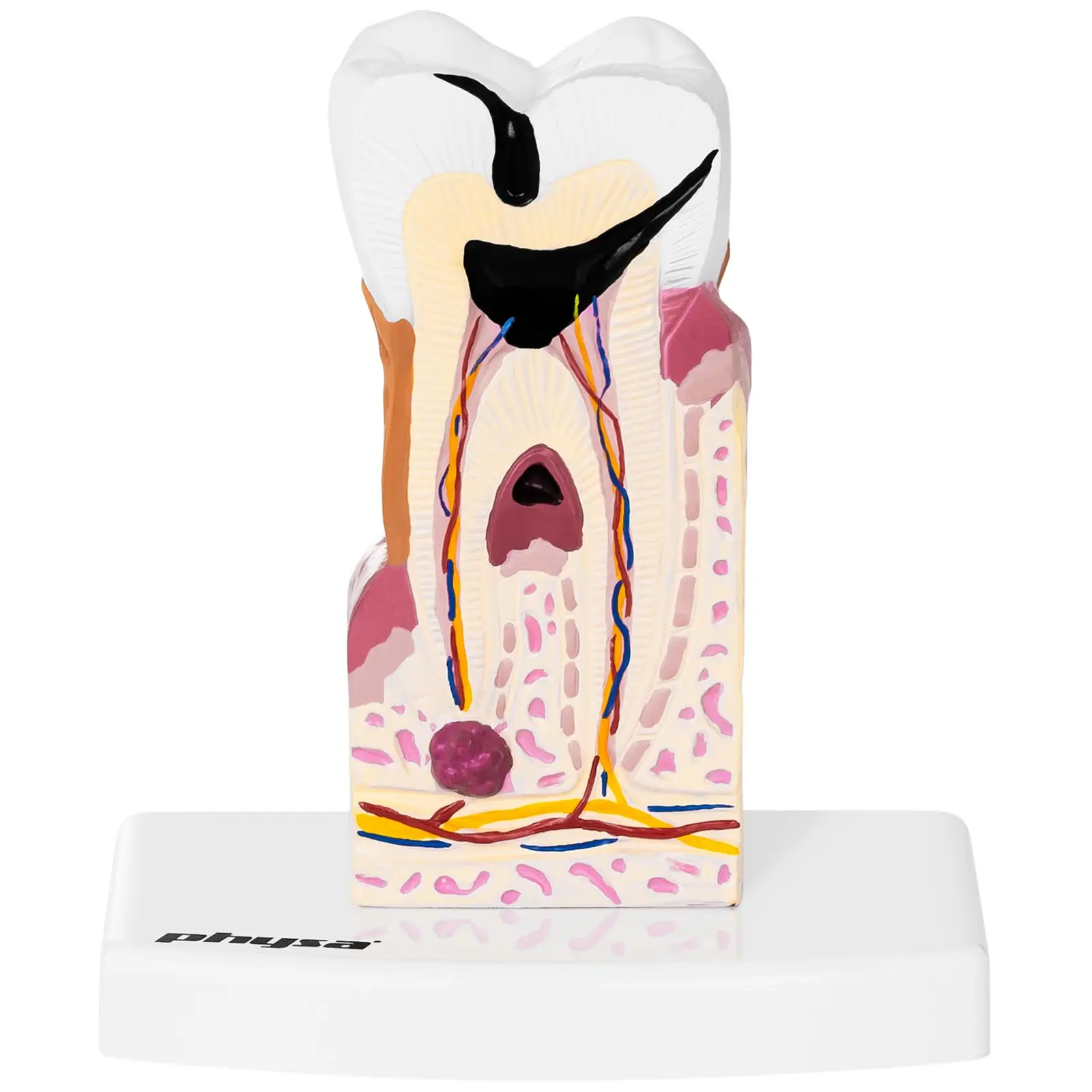 Modelo de diente - molar enfermo