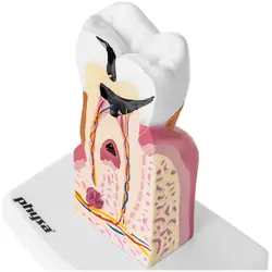 Tandmodel met aandoeningen