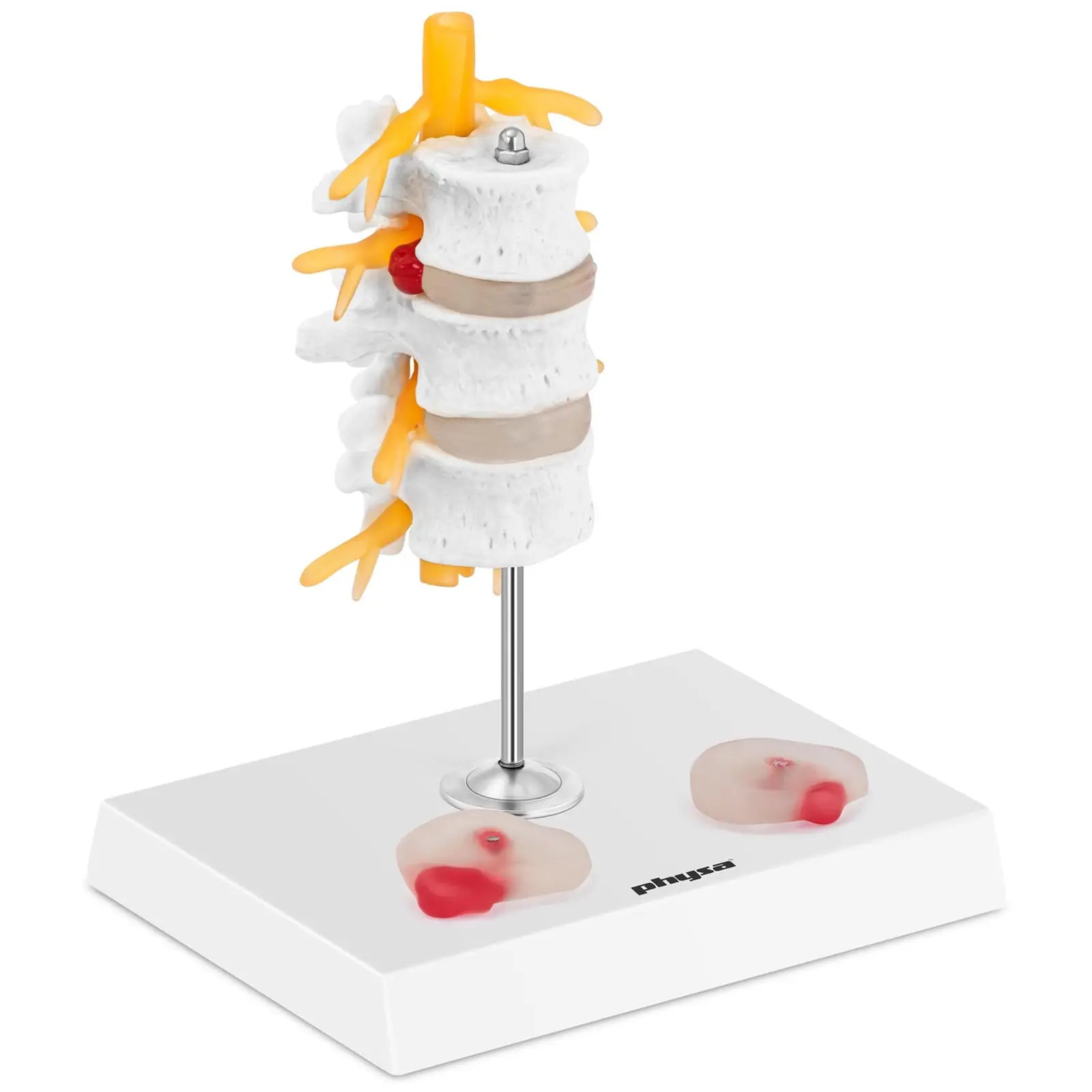 Odcinek lędźwiowy z przepukliną kręgosłupa - model anatomiczny