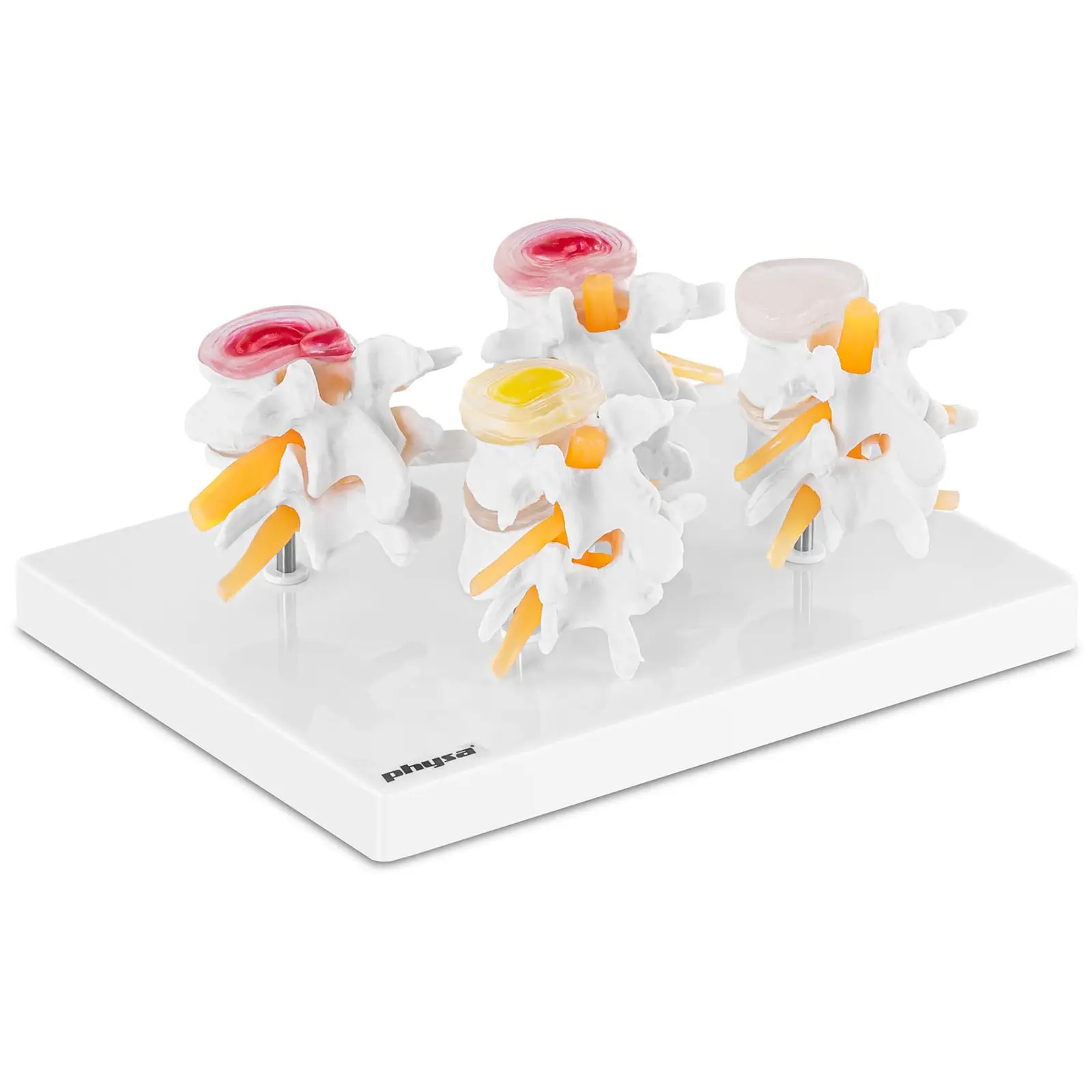 Outlet Zwyrodnienia odcinka lędźwiowego - 4 etapy - model anatomiczny