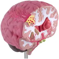 Brain Model - pathological - full-colour