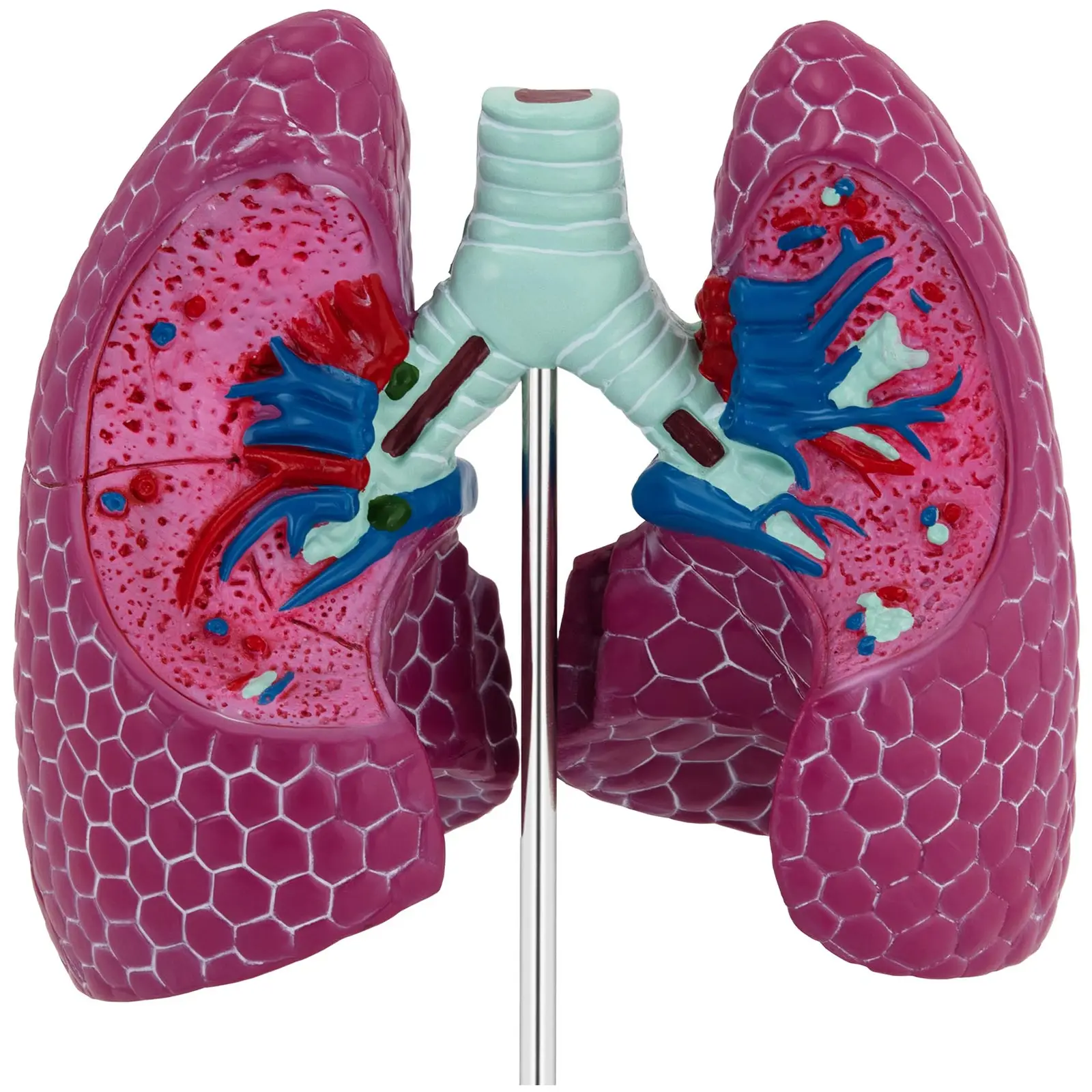 Modelo anatómico pulmonar - con patologías